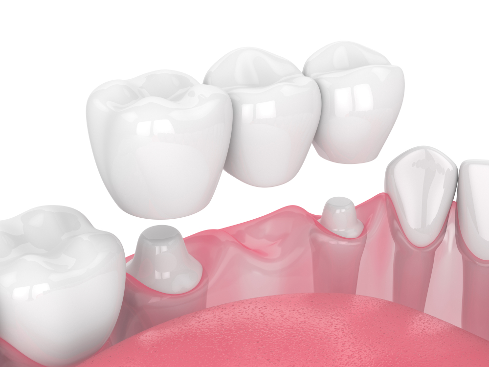 3D render of dental bridge