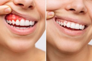 before picture of gum disease inflammation, after picture post-gum disease treatment