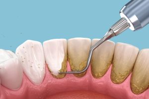 scaling and root planing treatment for periodontal disease