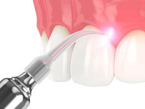 3d render of dental laser therapy