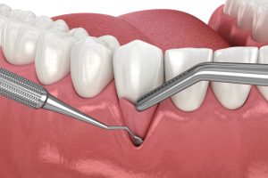 gum grafting also known as soft tissue grafting