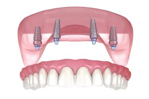 denture supported by dental implants