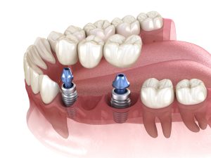 dental implants support bridge of three teeth