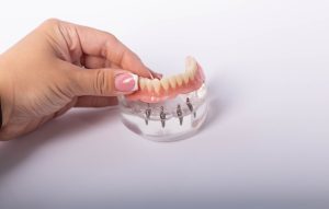 model of all-on-4 dental implants