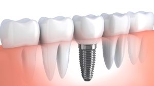 single-tooth implant